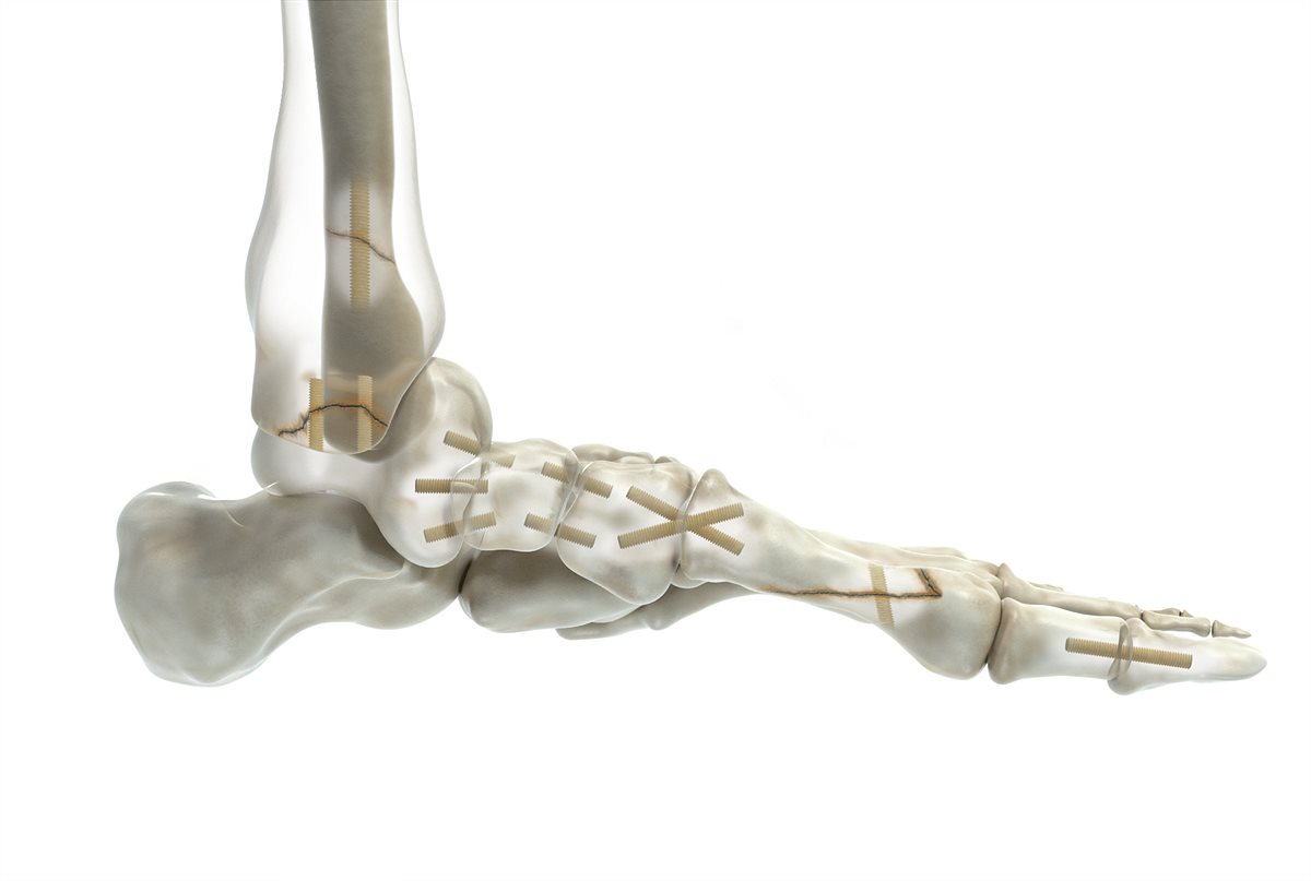 Shark Screw® Indikationen an Fuß Arthrodesen und Frakturen